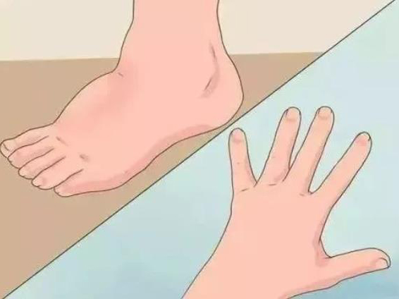 水腫